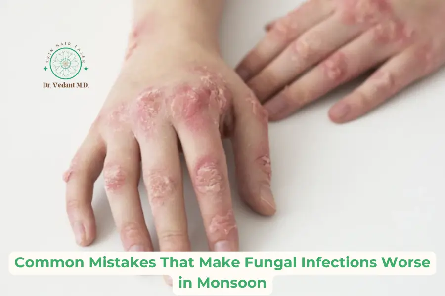 Monsoon Fungal Infection Mistakes|Skin Dermatologist Near Me