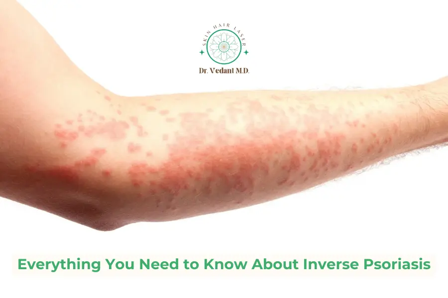 A Guide to Inverse Psoriasis | Dermatologist Near Me For Skin