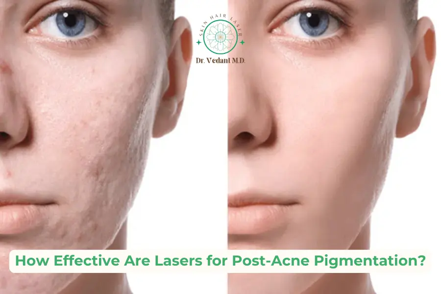 Lasers and Acne Pigmentation | Laser Treatment for Face